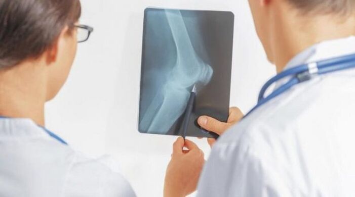 Após o diagnóstico necessário de artrose da articulação do joelho, os médicos prescrevem um tratamento complexo