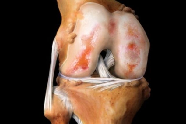 Destruição da articulação do joelho devido à artrose - uma patologia comum do sistema músculo-esquelético