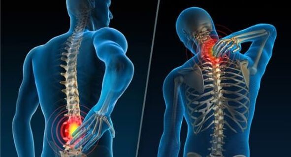 Sinais que indicam o desenvolvimento de osteocondrose - dores no pescoço e na região lombar