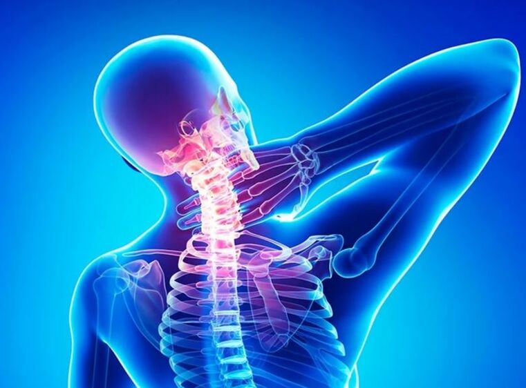 Osteocondrose da coluna cervical