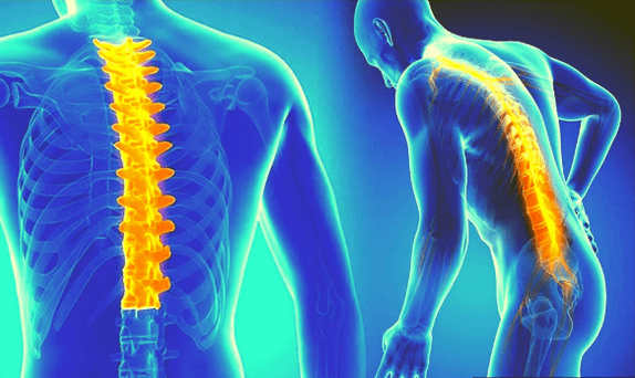Osteocondrose da coluna