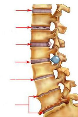 Como a osteocondrose se desenvolve