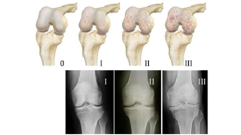 Estágios da artrose da articulação do joelho nas radiografias