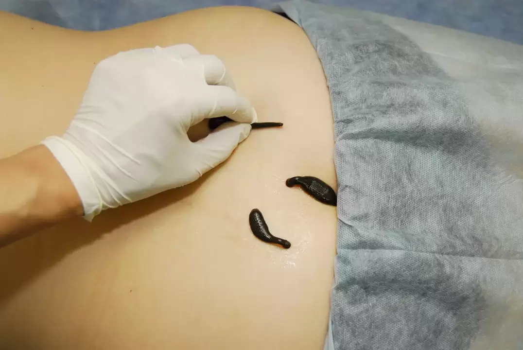 colocação de sanguessugas para osteocondrose lombar