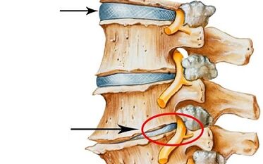 estágios de desenvolvimento da osteocondrose cervical