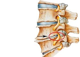 causas da osteocondrose cervical