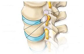 principais sintomas da osteocondrose cervical