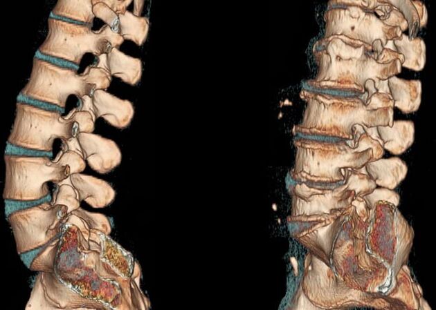 Tomografia computadorizada da coluna lombar em condições normais e com osteocondrose