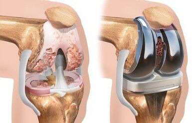 Endopróteses da articulação do joelho com gonartrose