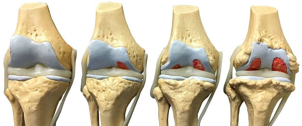 Graus de artrose da articulação do joelho